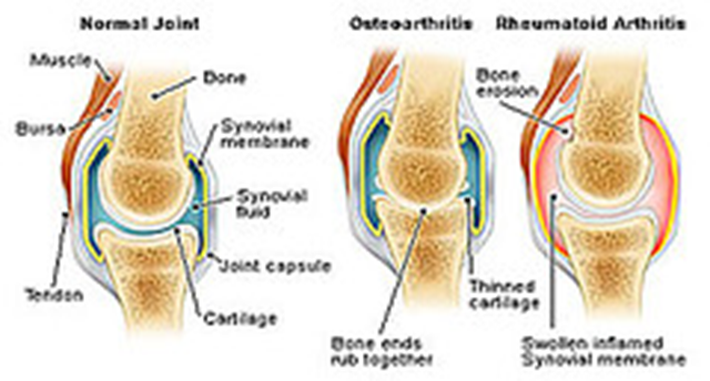 Osteoarthritis generally affects the weight-bearing joints such as the knee, 