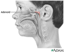 image_thumb ENLARGED ADENOIDS AND HOMEOPATHY