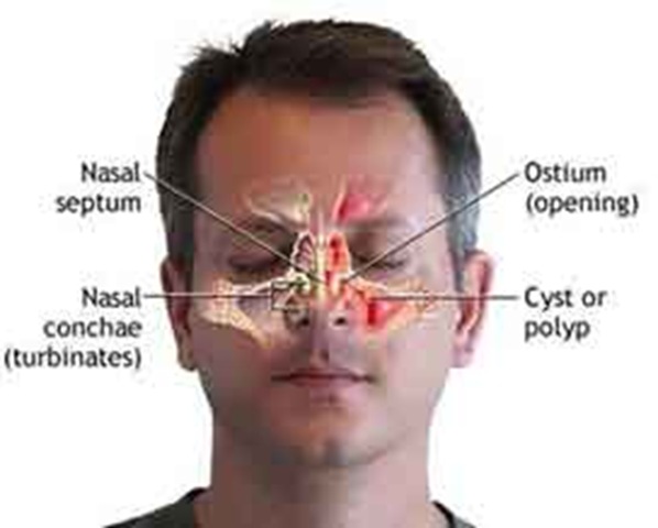 Nasal Polyps and Homeopathy