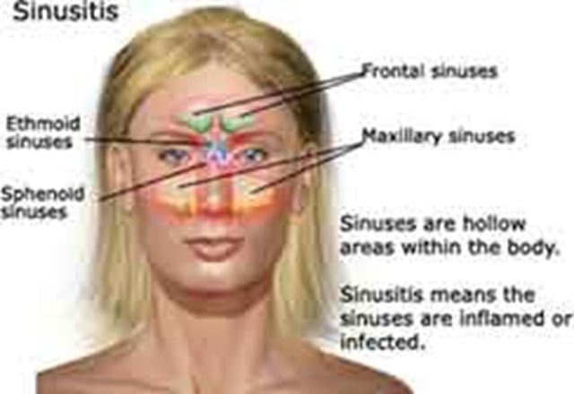 Facial Sinus 68