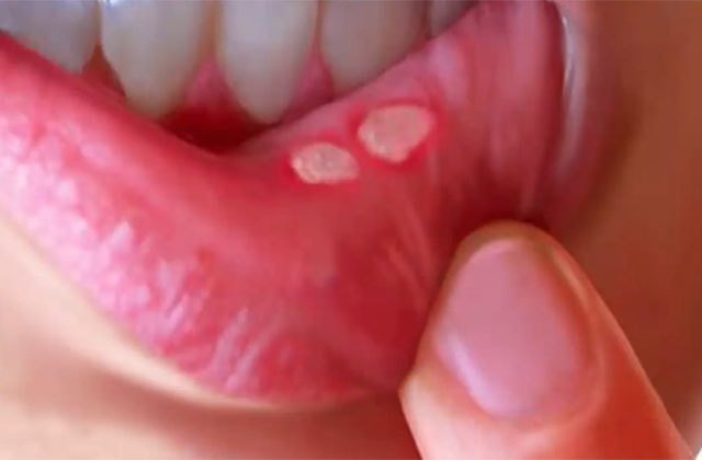 Homeopathic Medicines For Mouth Ulcers Homeopathy Treatment