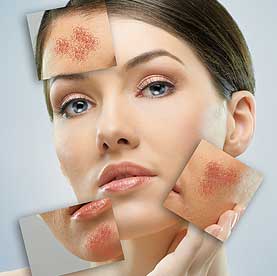 Homeopathic Remedies for Acne Rosacea