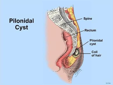  Homeopathic Remedies for Pilonidal Cyst