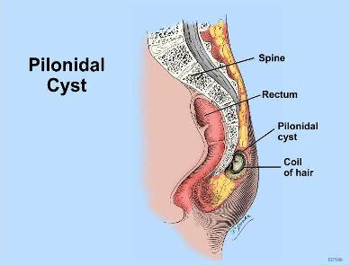 http://www.drhomeo.com/wp-content/uploads/2014/01/Pilonidal-Sinus-Structure.jpg