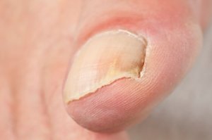 Homeopathic Remedies for Nail Fungus