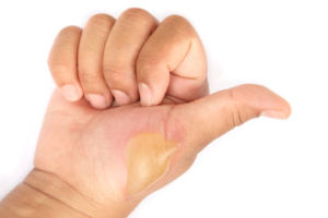 Homeopathic Remedies for skin burns