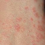 homeopathic medicines for scabies