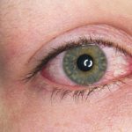 homeopathic medicines for uveitis 