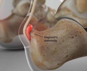 Haglund’s deformity