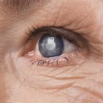 homeopathic remedies for cataract