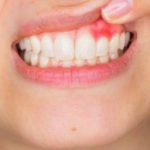 Homeopathic Medicines for Pyorrhea