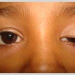 homeopathic remedies for ptosis