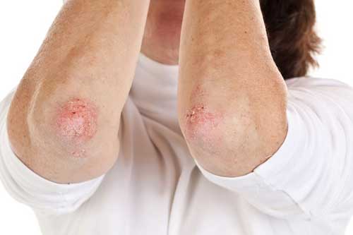 psoriasis treatment in karachi