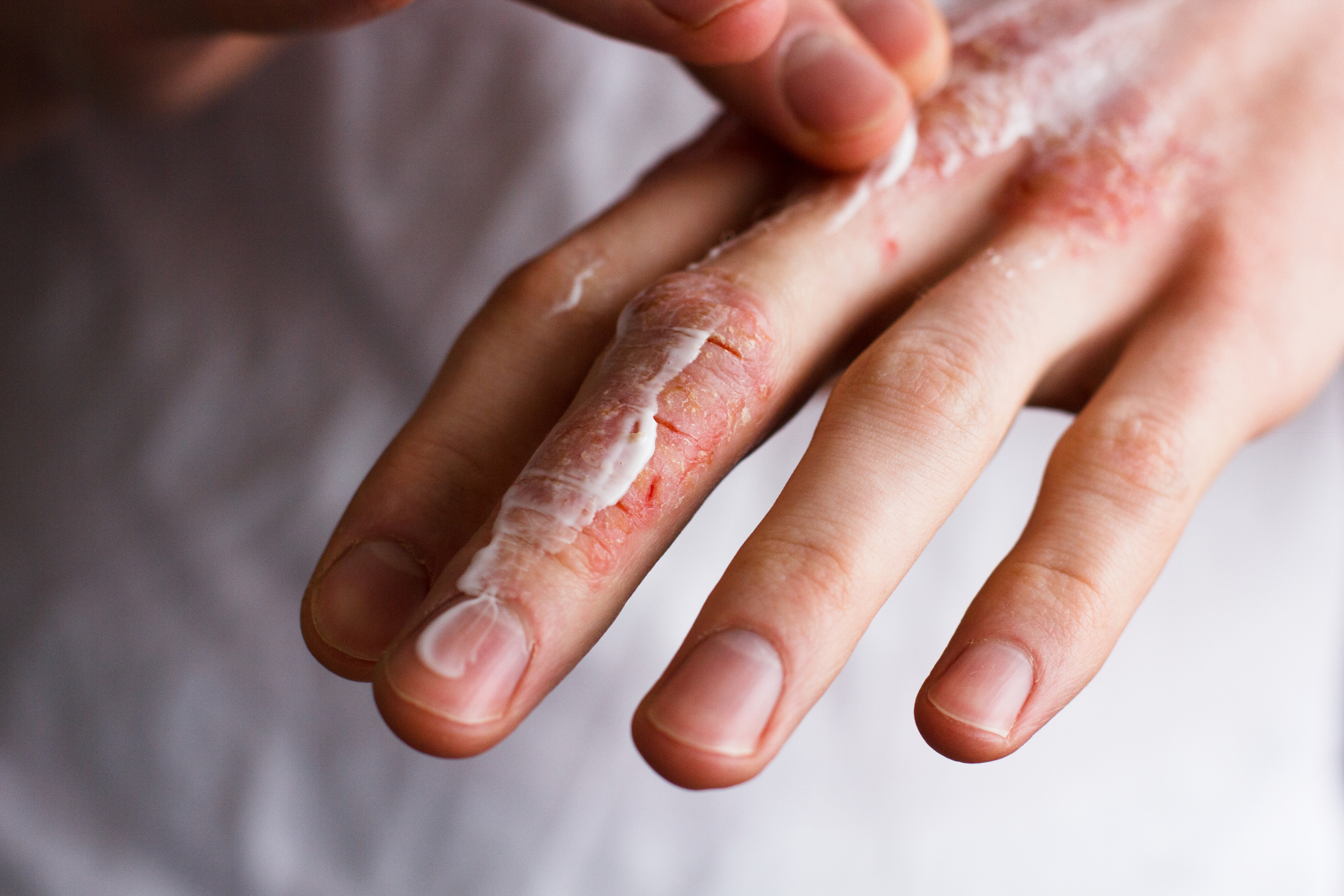 Home treatment for dry cracked hands