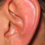 homeopathic treatment for ear discharge