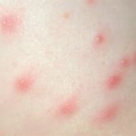 Homeopathic Medicines for Folliculitis 