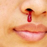 Homeopathic Treatment for Epistaxis