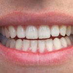 homeopathic medicines for bruxism 