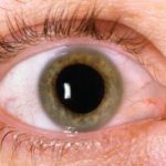 homeopathic medicines for dry eyes