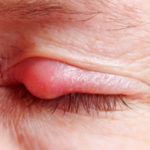 homeopathic remedies for stye 