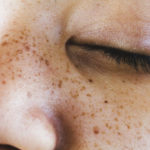 homeopathic medicines for freckles
