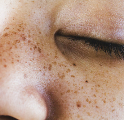 dark spot removal homeopathic cream