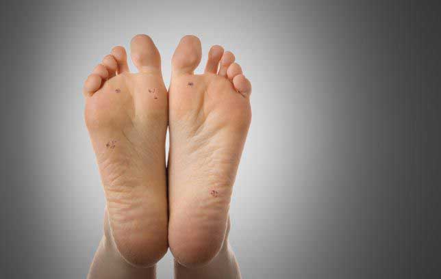 corn foot treatment homeopathic