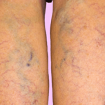 homeopathic medicines for varicose veins 