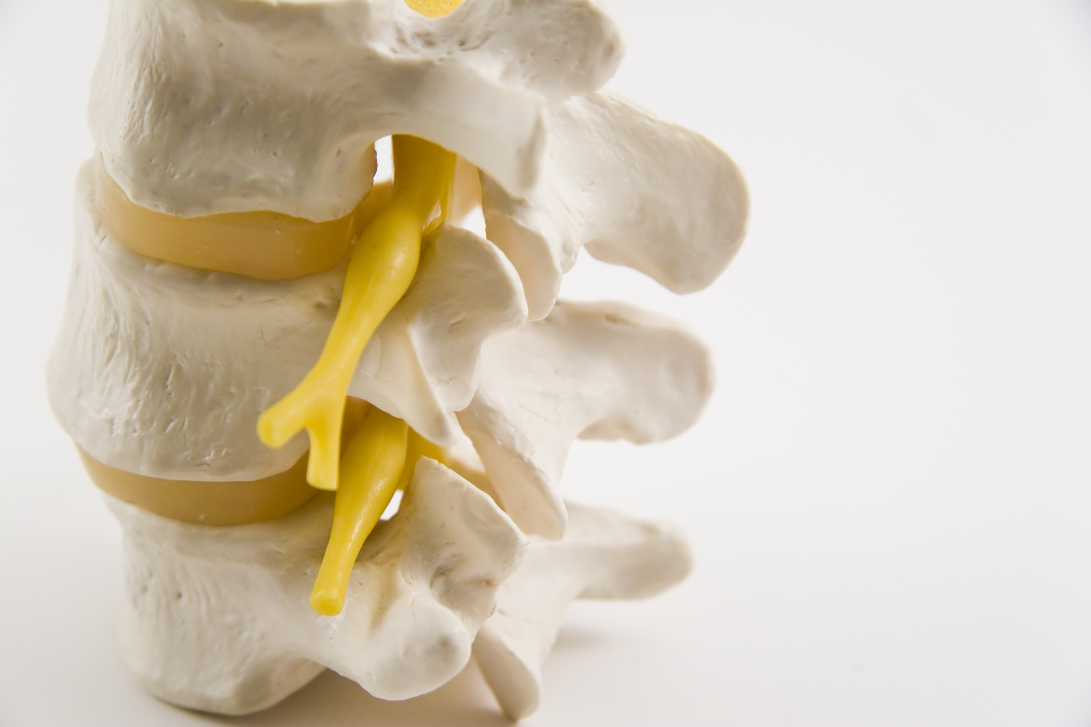 Natural Treatment of Pinched Nerve with Homeopathy Homeopathy at