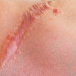 scars homeopathy