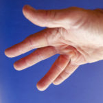 homeopathy Dupuytren's Contracture 