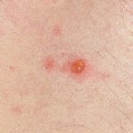 Natural Treatment of Chickenpox with Homeopathy - Homeopathy at DrHomeo.com