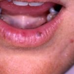 homeopathy oral lichen planus 