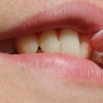 homeopathic medicines for bleeding gums