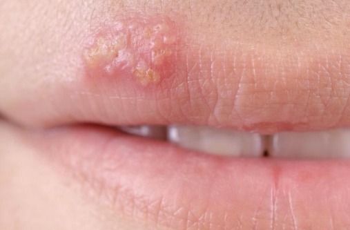 What Causes Water Blisters On Your Lips