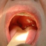  homeopathic medicines for quinsy