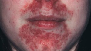 Perioral Dermatitis