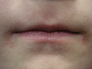 Homeopathic Medicines for Angular Cheilitis 