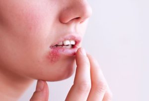 Homeopathic medicines for EBV