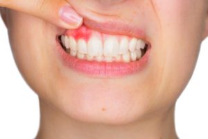Homeopathic Remedies for Periodontitis 