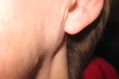 pleomorphic adenoma treatment in homeopathy