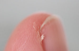 Homeopathic Medicines for Hangnails
