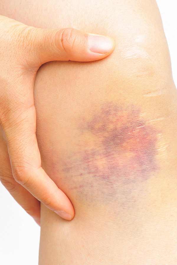 Homeopathic treatment for bruises -