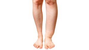 Filariasis Filariasis
