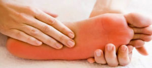 Homeopathic medicines for burning feet Homeopathic medicines for burning feet