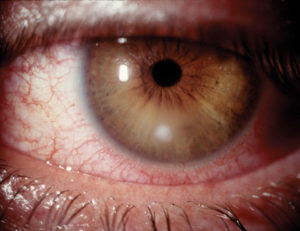 Supportive Role of Homeopathy for Corneal Ulcer Supportive Role of Homeopathy for Corneal Ulcer