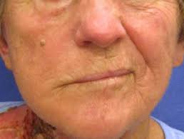 Homeopathic medicines for Ramsay Hunt Syndrome Homeopathic medicines for Ramsay Hunt Syndrome