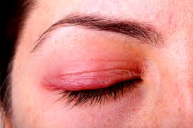 Homeopathic Medicines for Atopic Keratoconjunctivitis Homeopathic Medicines for Atopic Keratoconjunctivitis