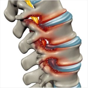 homeopathy for spinal stenosis 