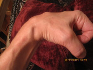 Homeopathic treatment for exostosis Homeopathic treatment for exostosis